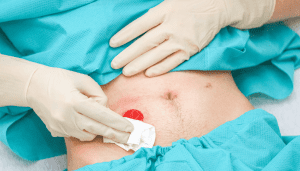 Hernia