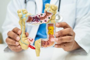How I Knew I Had Colon Cancer?