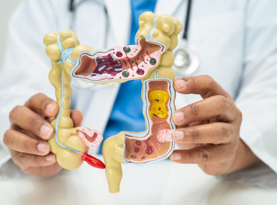 How I Knew I Had Colon Cancer?