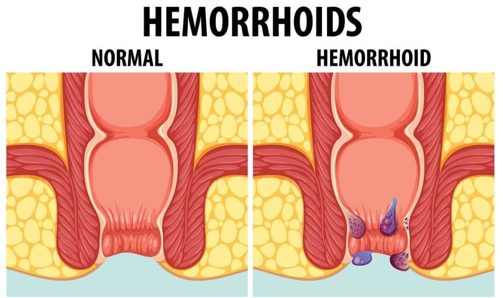 What Do Hemorrhoids Look Like Leicester Bowel Clinic what-do-hemorrhoids-look-like-leicester-bowel-clinic