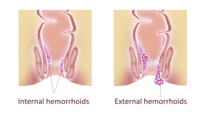 Internal vs External Haemorrhoids