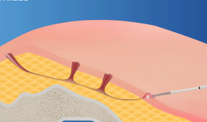 Pilonidal laser surgery
