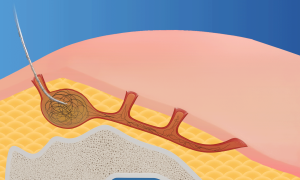 What is a Pilonidal Sinus