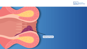 Haemorrhoids